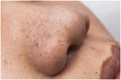 Лечение кожи лица - угрей в Махачкале